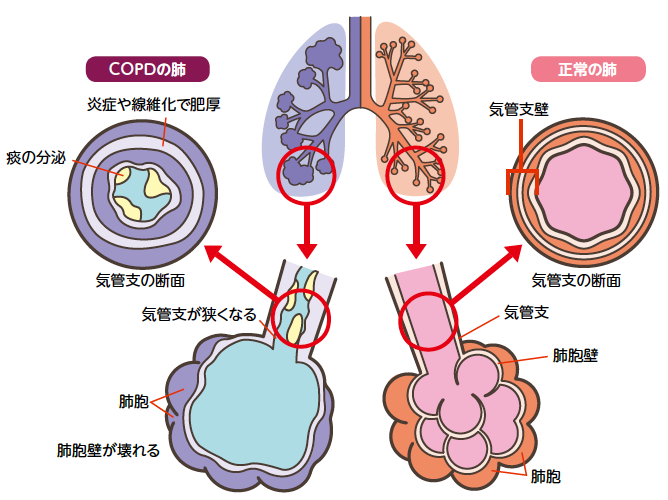 正常な肺とCOPDの肺
