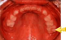 上の歯の6歳臼歯の写真
