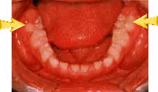 下の歯の6歳臼歯の写真